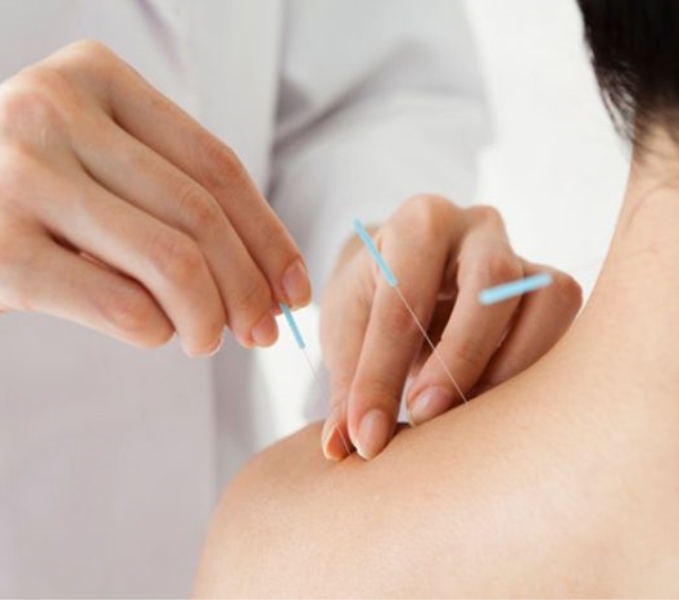 Châm Cứu - Phương Pháp Điều Trị Đau và Cải Thiện Sức Khỏe